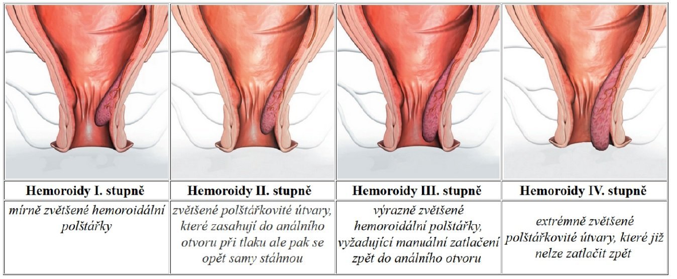  hemeroidy stupně