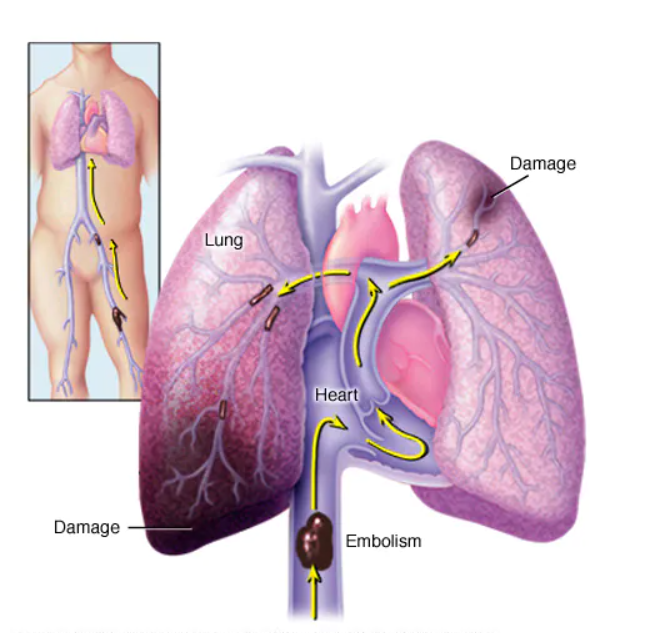 plicní embolie 