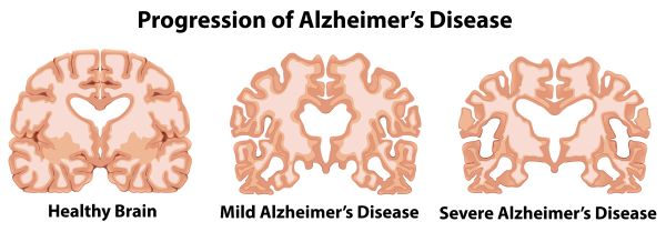 alzheimerova choroba