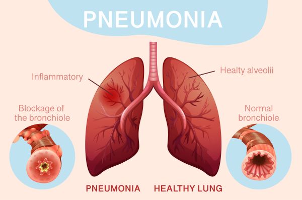 pneumonie