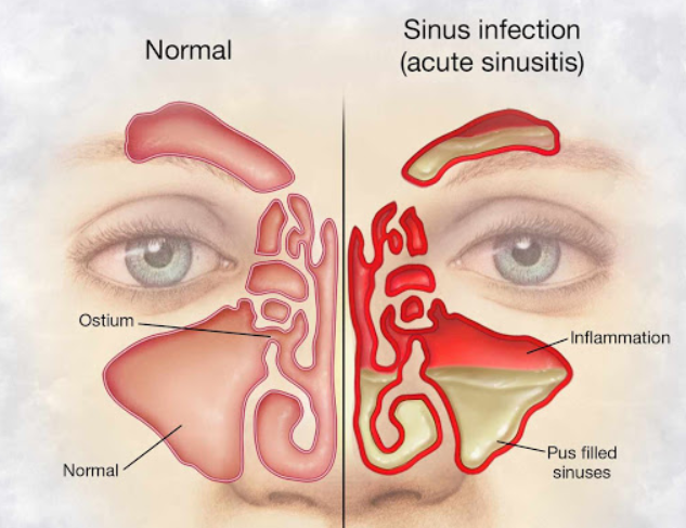 sinusitida