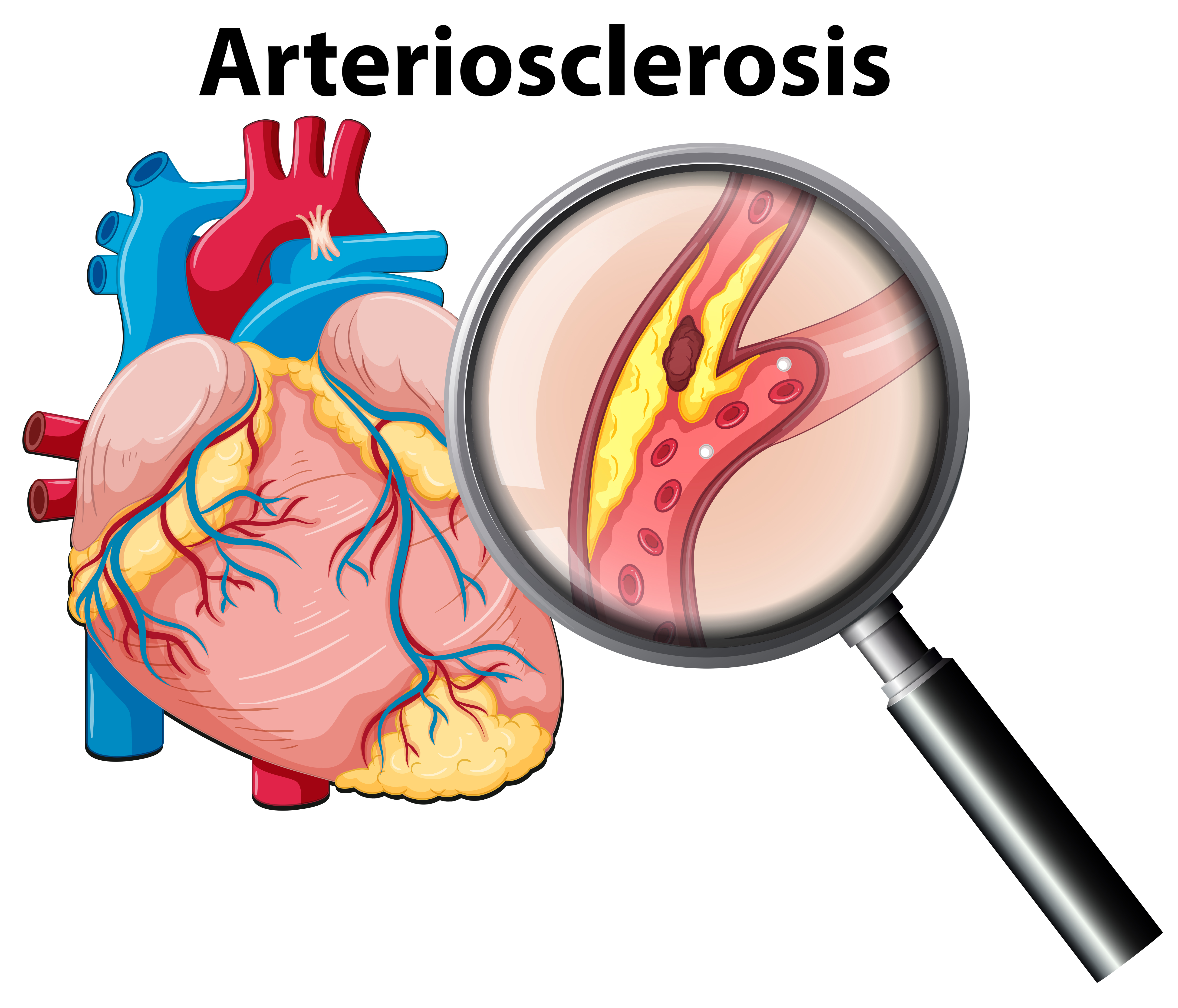 ateroskleróza