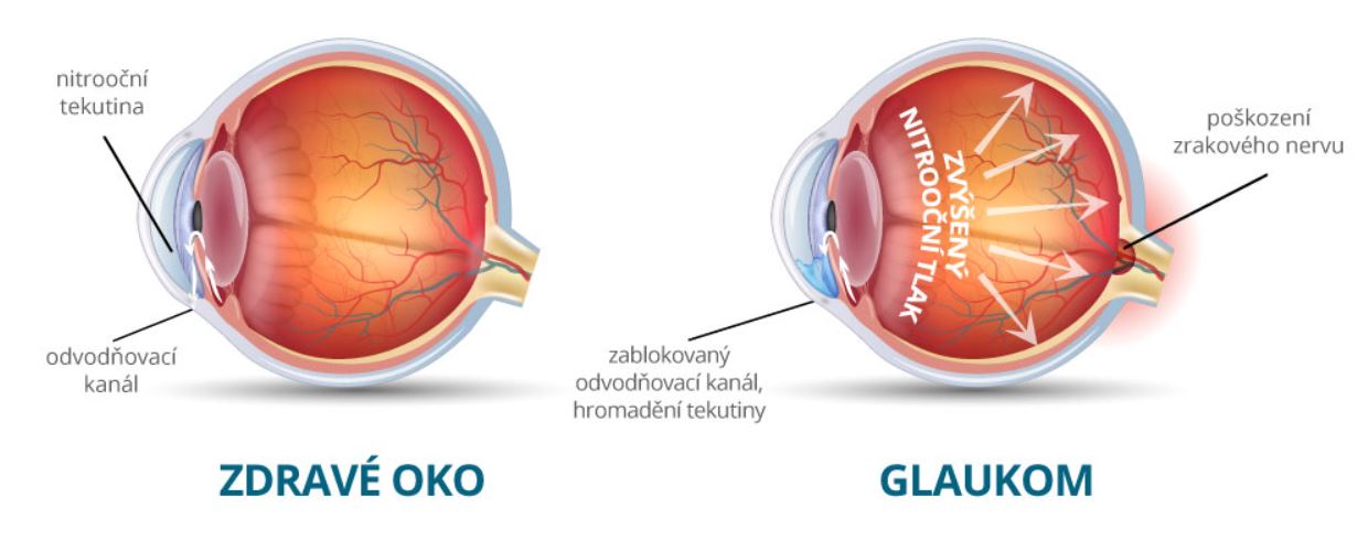 Jak zabránit vzniku krátkozrakosti?