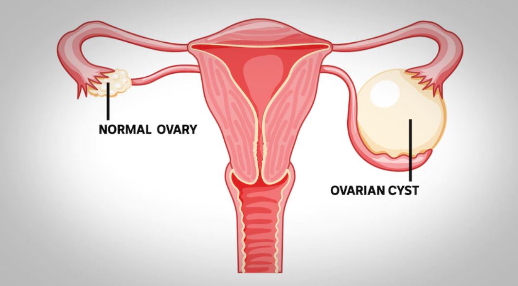 ovariální cysta