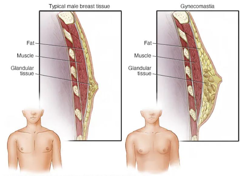 Co je Pseudogynekomastie?