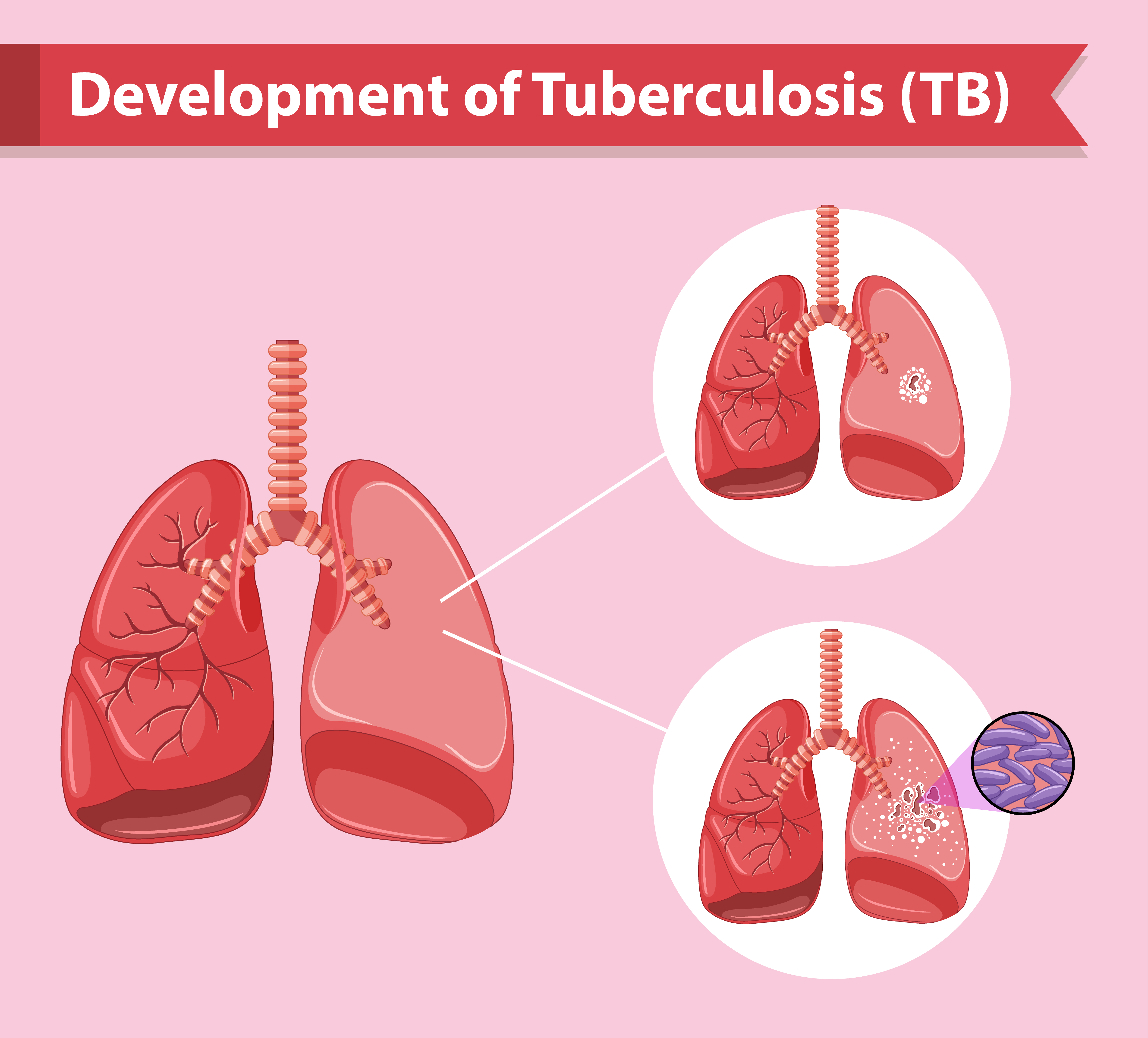 pľúca tuberkulóza