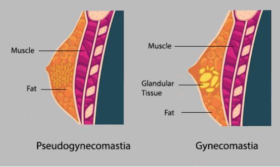 pseudogynekomastia