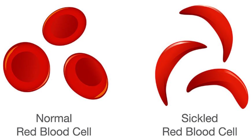 srpkovitá anémie