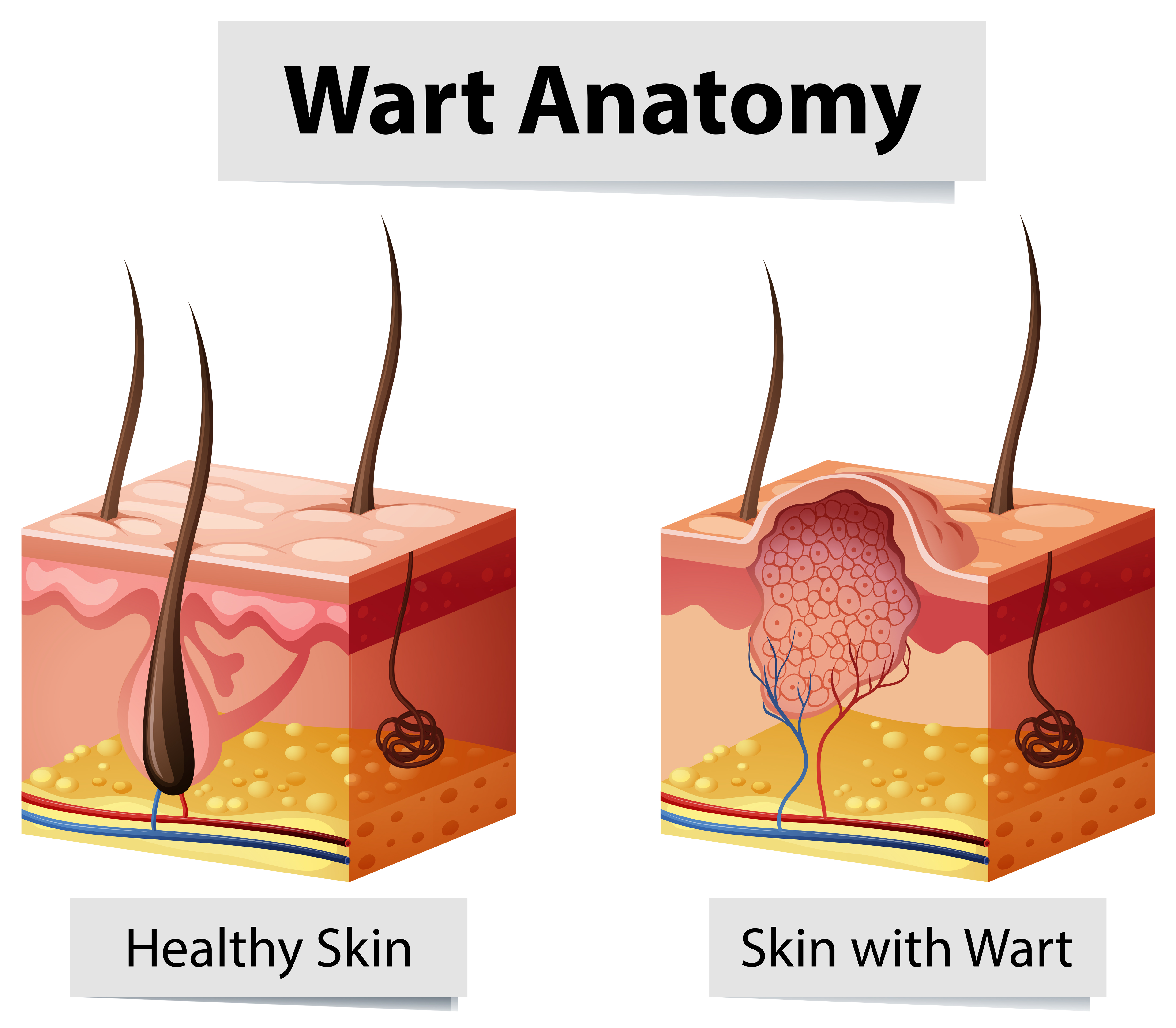 bradavice anatomie