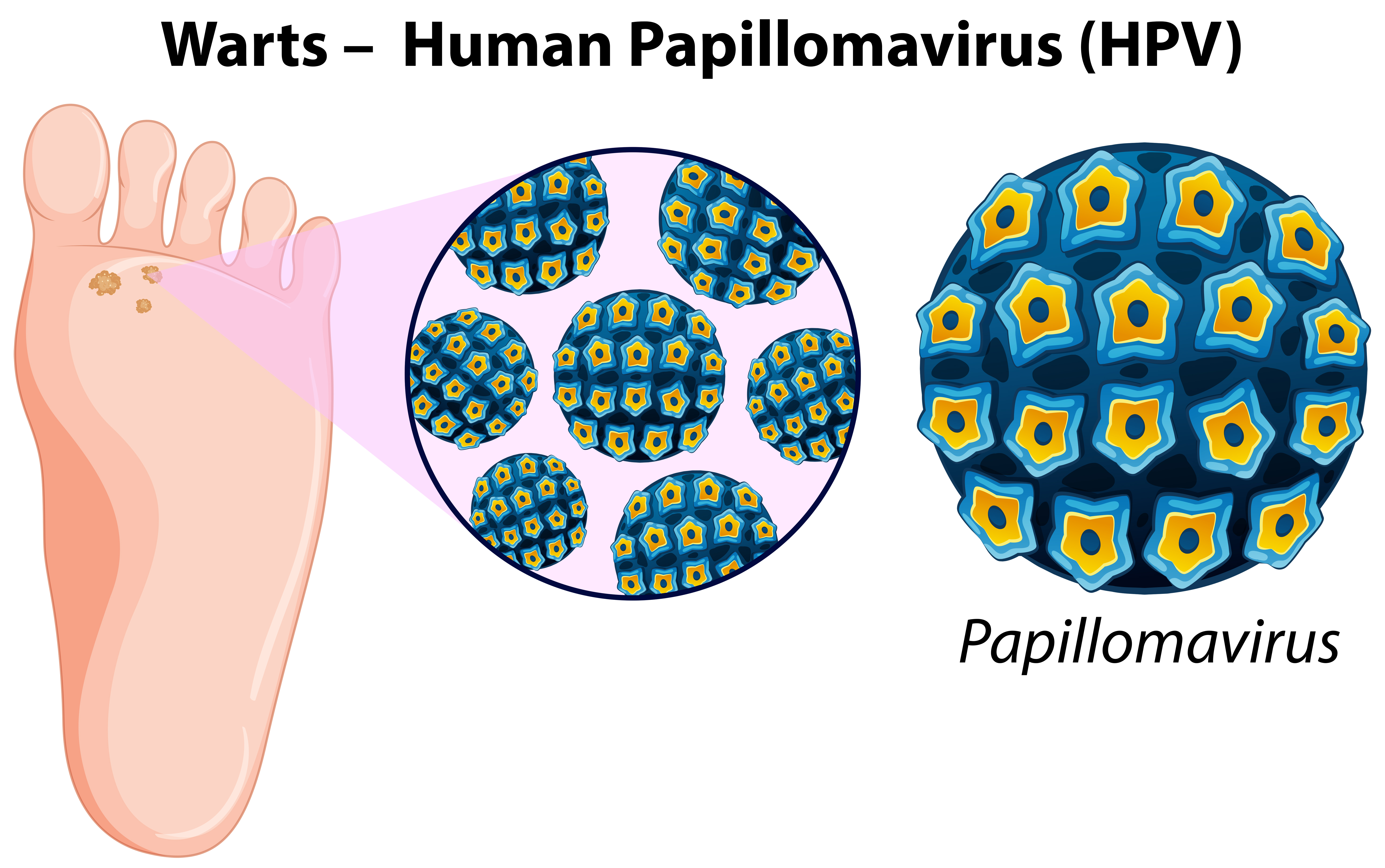 bradavice virus