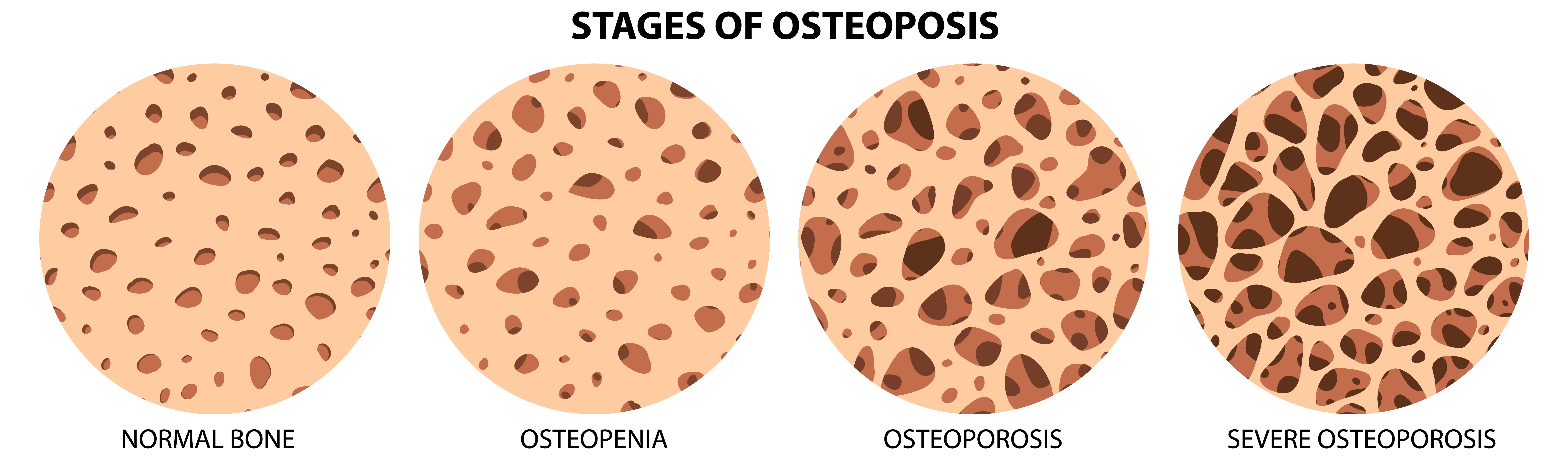 osteoporoza