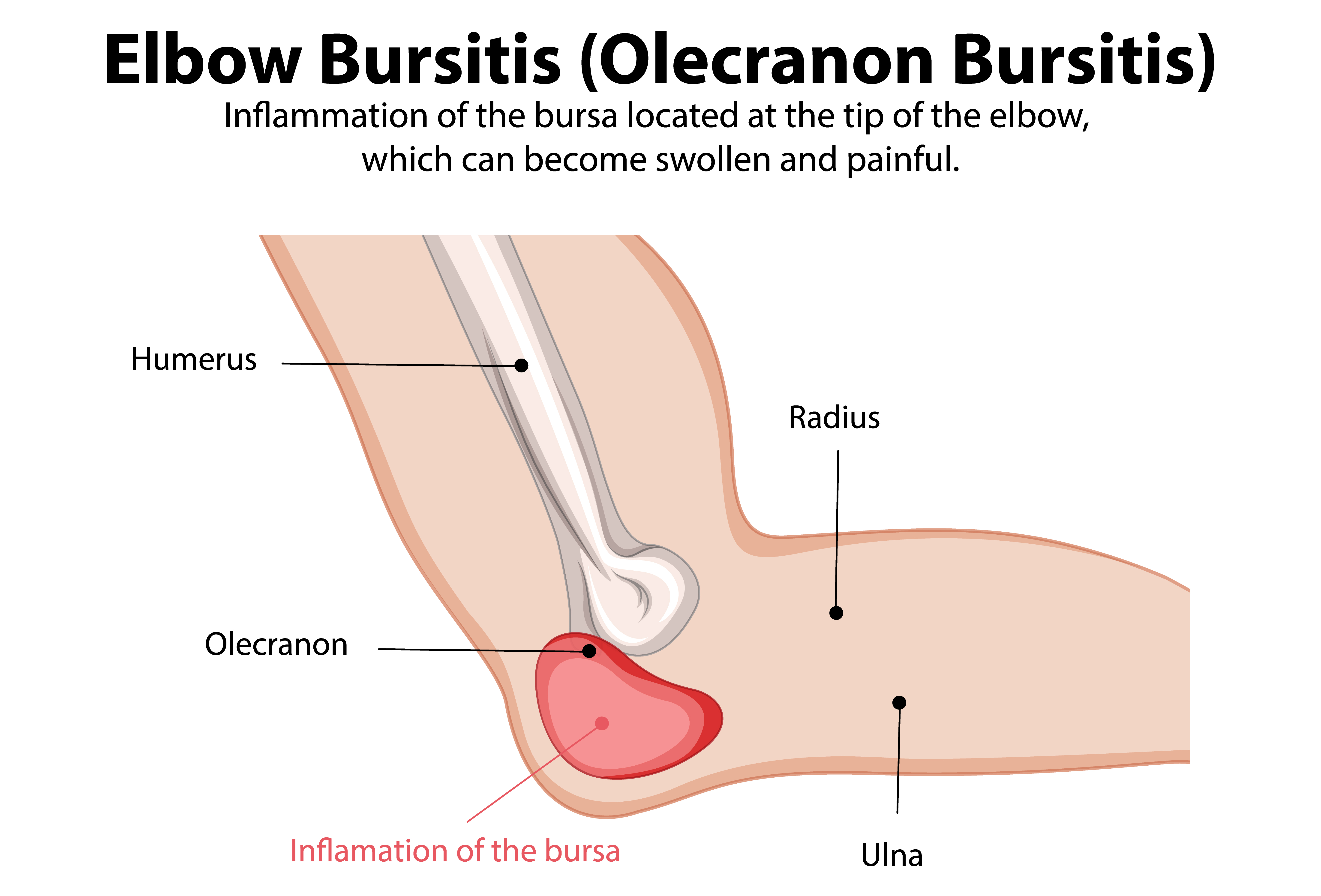 bursitida