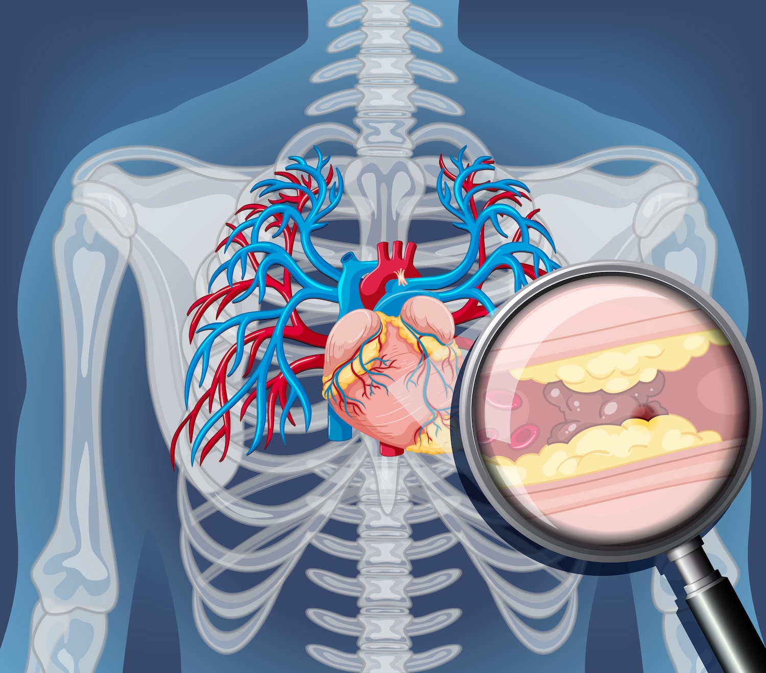 cholesterol