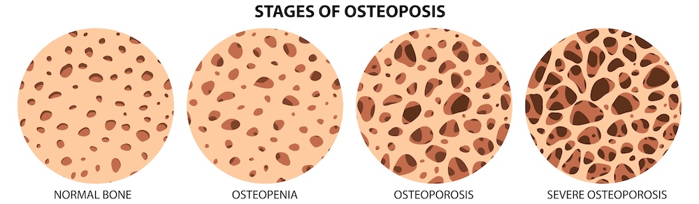 osteopozora