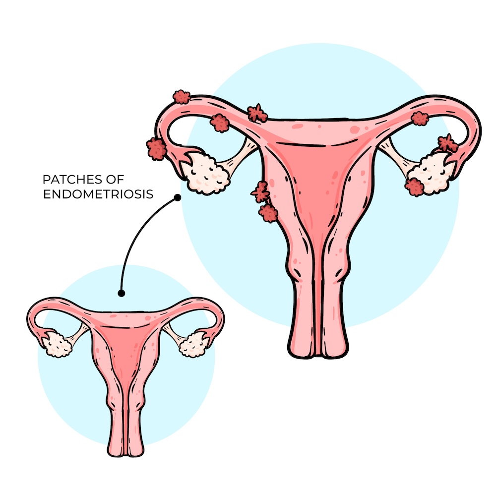 endometrioza info