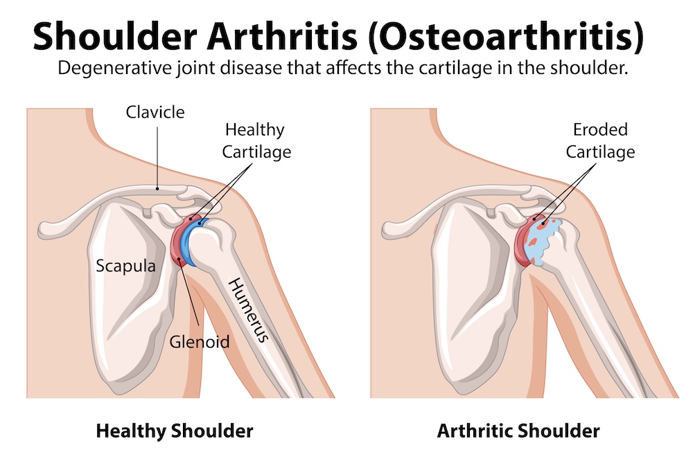 osteoartroza ramene