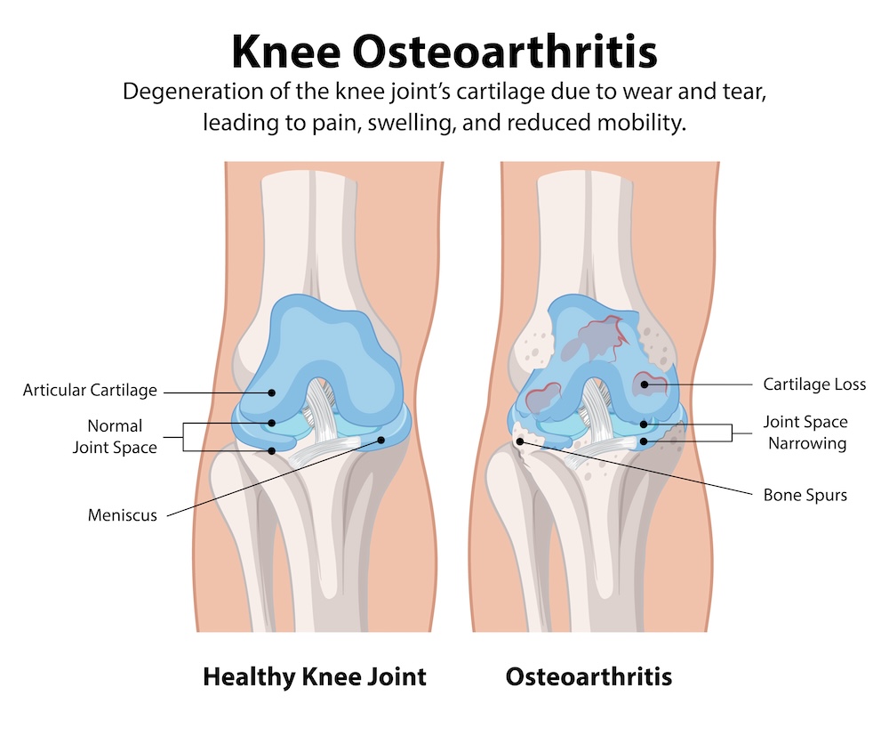 osteoartróza