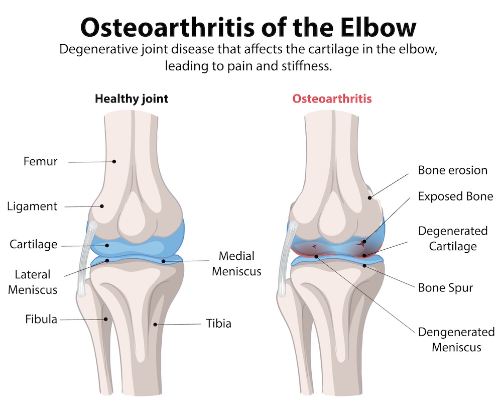 osteoartróza loktu