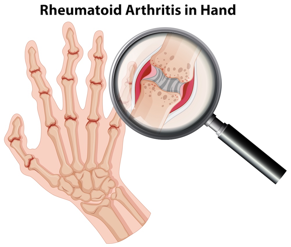 revmatoidni artritida