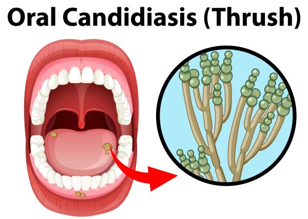 orální kandidóza