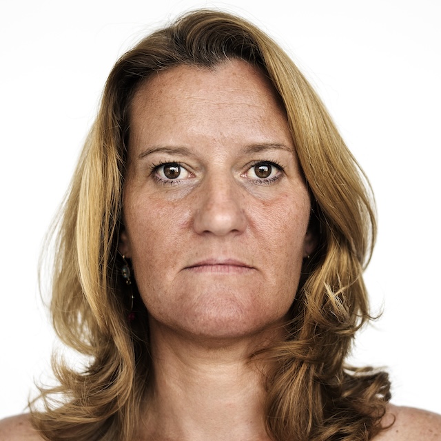 melasma