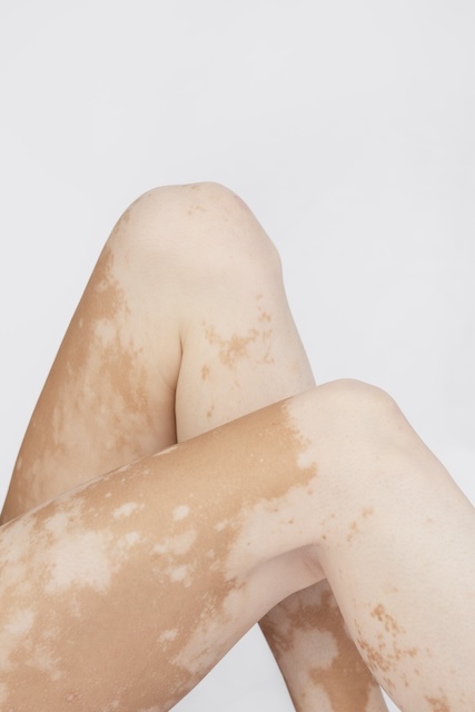 vitiligo